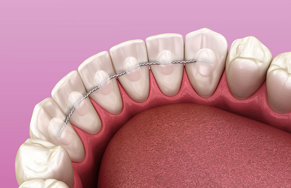 Orthodontie contention - Espace K dentaire Villecresnes - Dentiste Villecresnes