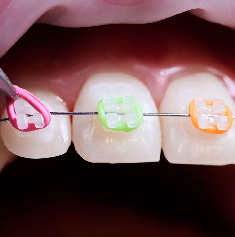 Orthodontie Villecresnes - Espace K dentaire Villecresnes - Dentiste Villecresnes