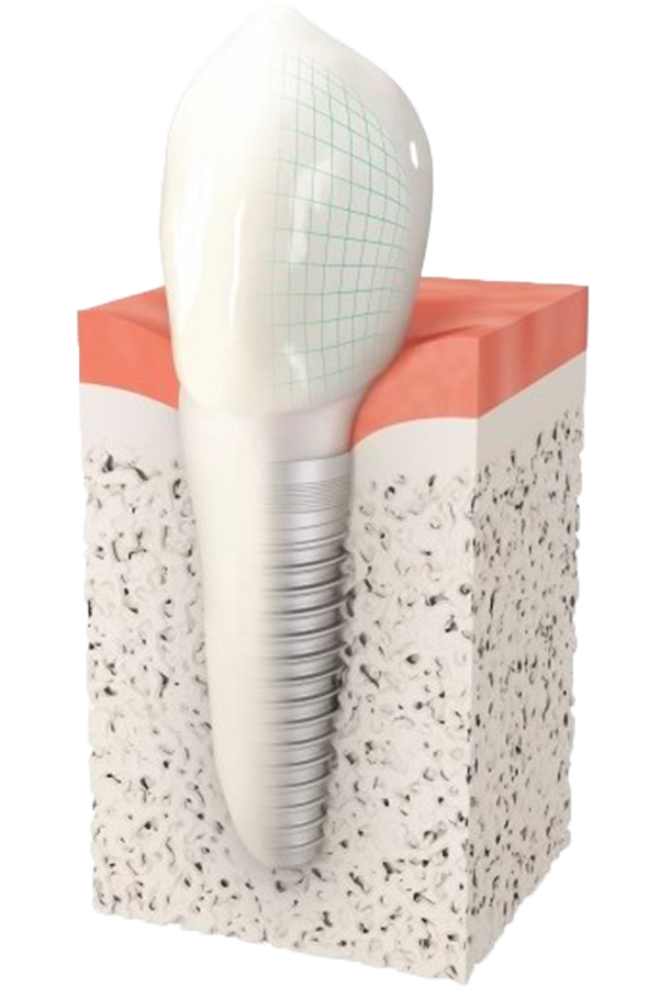 Implant dentaire Villecresnes - Espace K dentaire Villecresnes - Dentiste Villecresnes