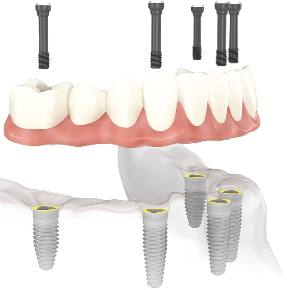 Implants dentaires Villecresnes - Espace K dentaire Villecresnes - Dentiste Villecresnes