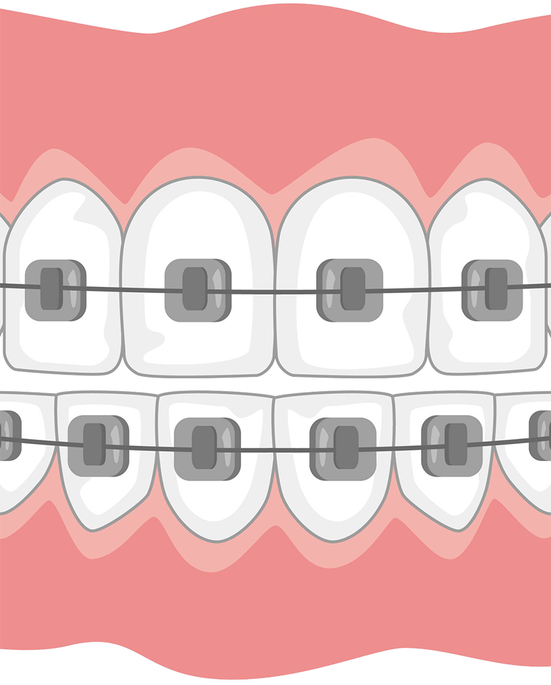 Orthodontie - Espace K dentaire Villecresnes - Dentiste Villecresnes